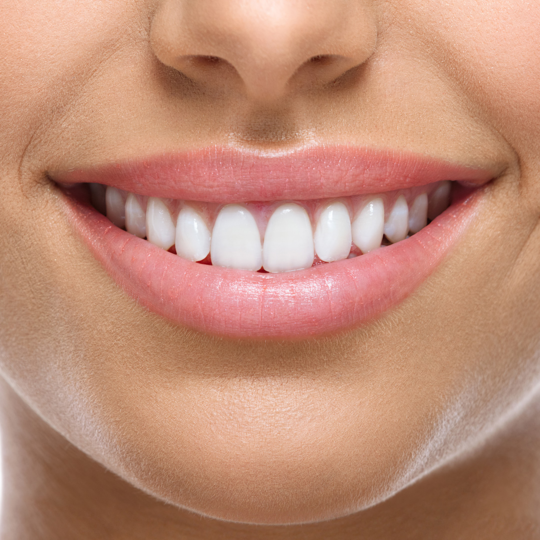 Rickmansworth-dentist-Inpsire-Dental-35 Teeth Whitening in Rickmansworth